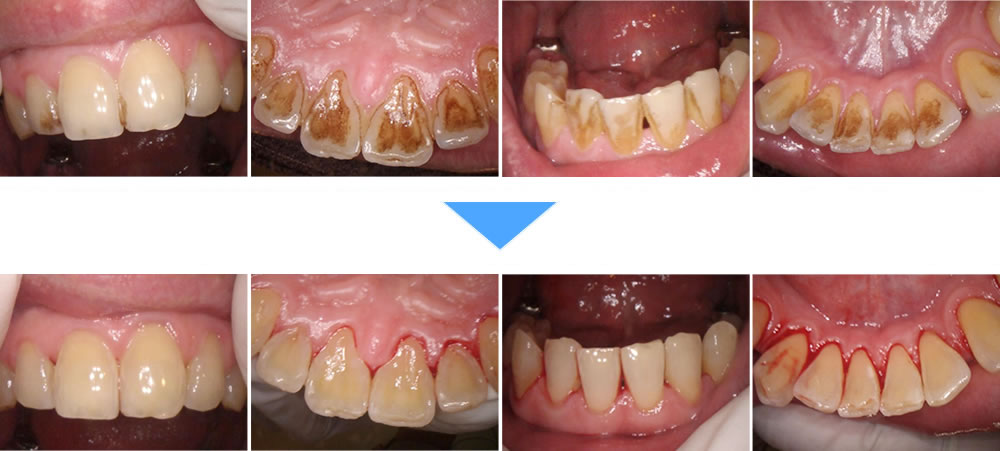 気になる歯の着色汚れをエアフローで除去した症例