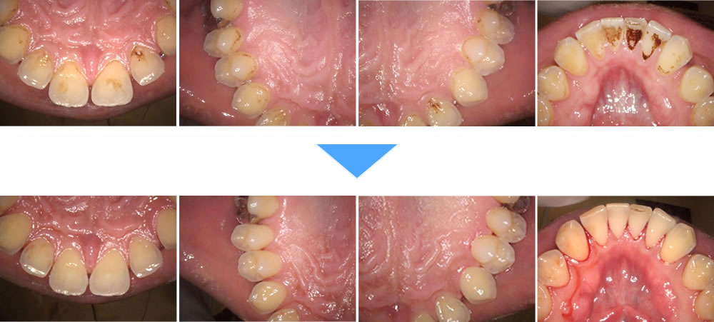 タバコのヤニ・着色汚れをエアフローで改善した症例