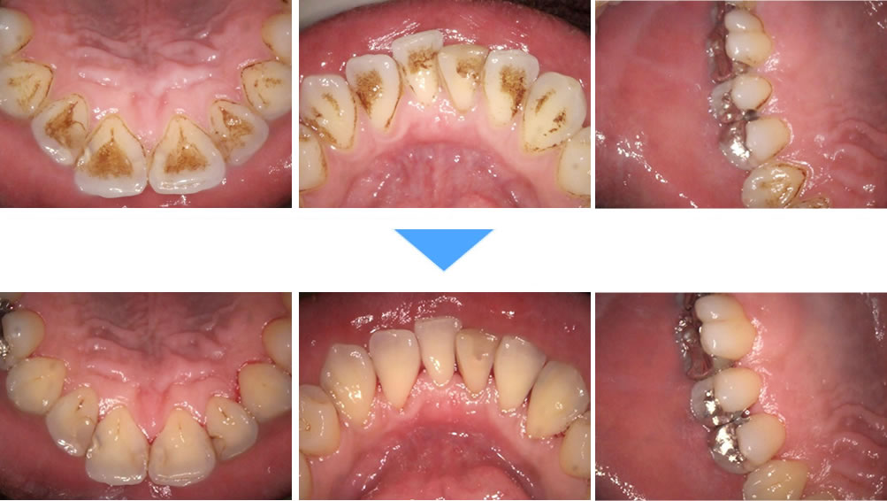 エアフローによる低侵襲な歯面清掃の症例