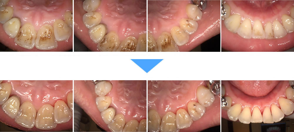 コーヒー・タバコによる着色汚れをエアフローで改善した症例