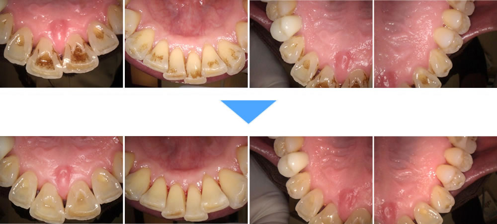 エアフローによるクリーニングで着色汚れを改善した症例