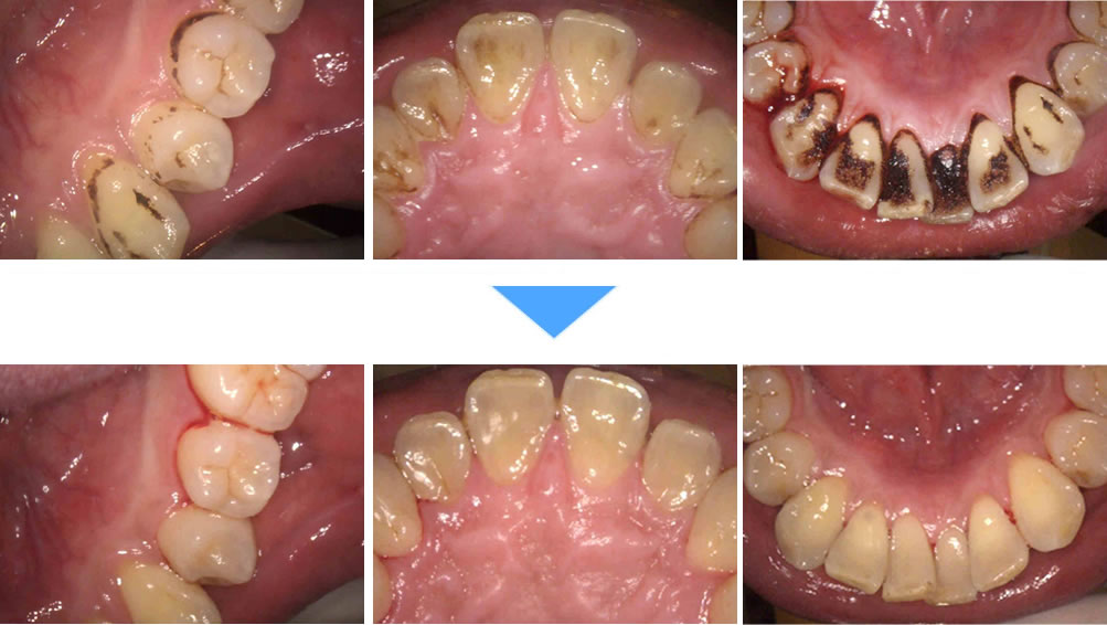 エアフローによるクリーニングで着色を除去した症例