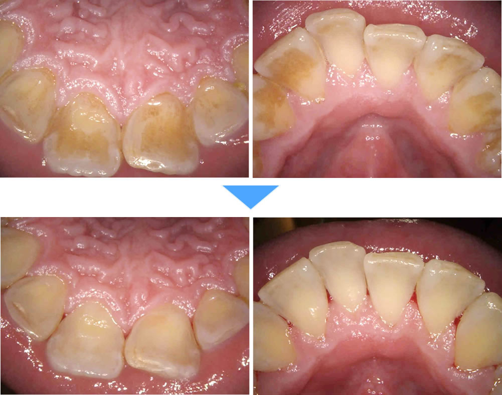 エアフロークリーニングで着色を取り除いた症例