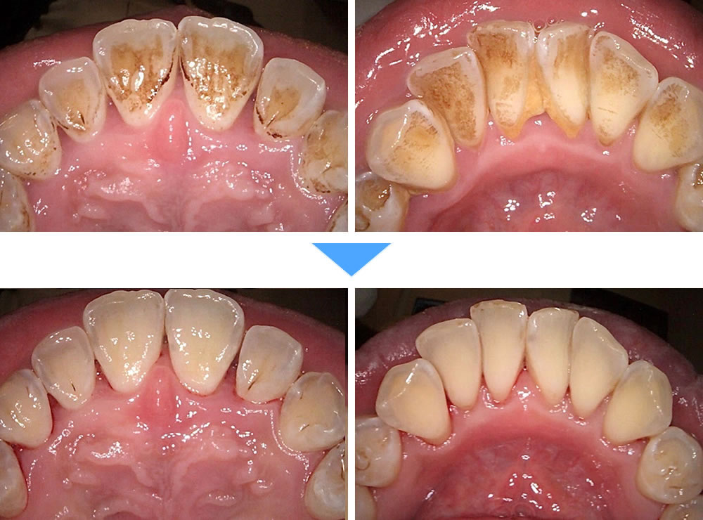  歯の着色をエアフロークリーニングで改善した症例