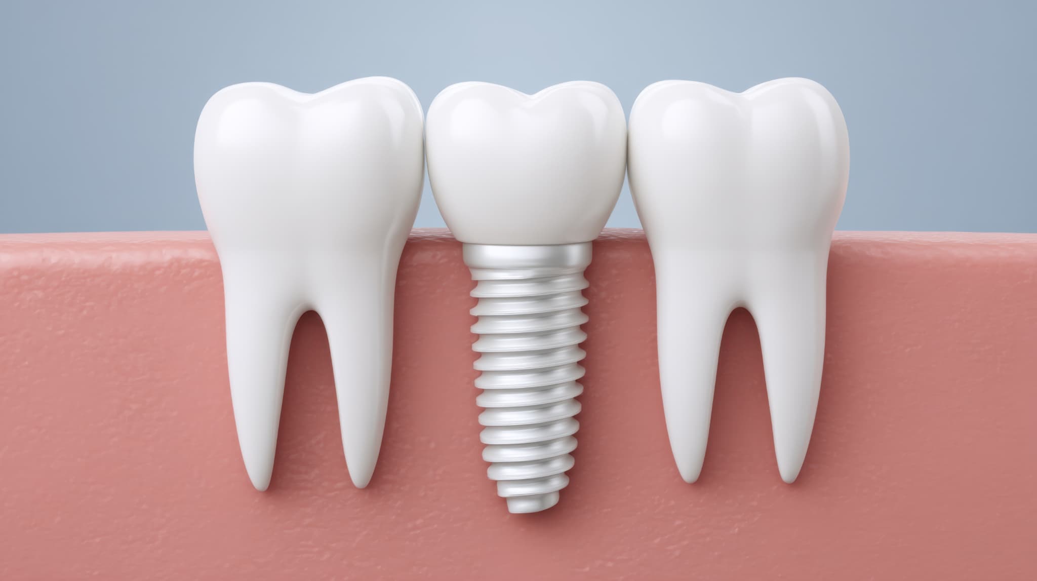 金属アレルギーでも治療可能なインプラント