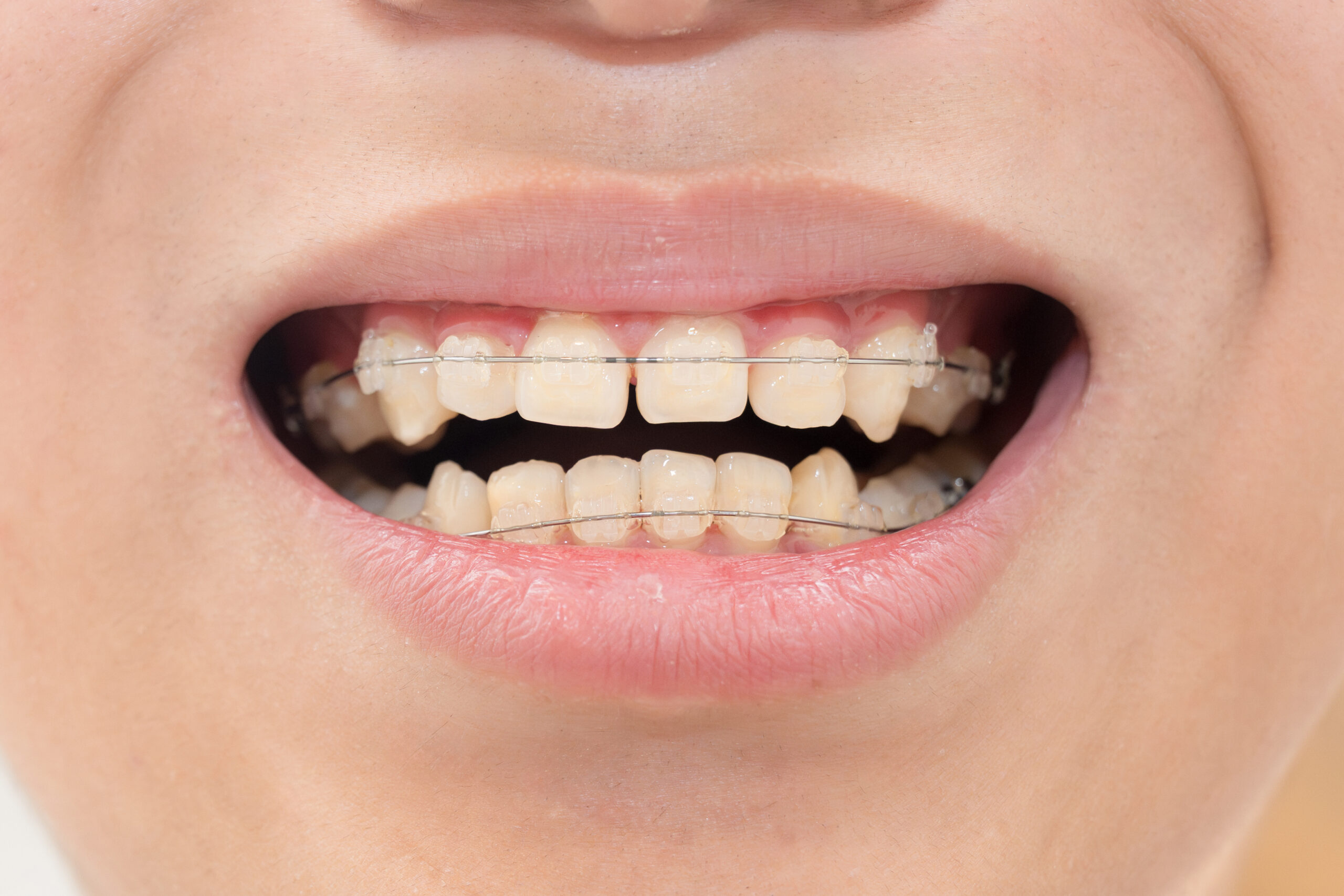 すきっ歯をワイヤー矯正で治療している