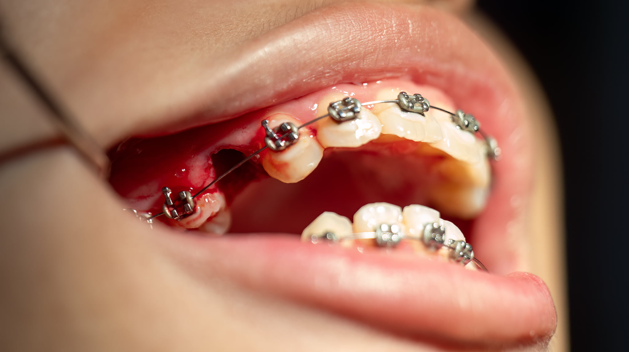 抜歯してワイヤー矯正をしている口元のイメージ